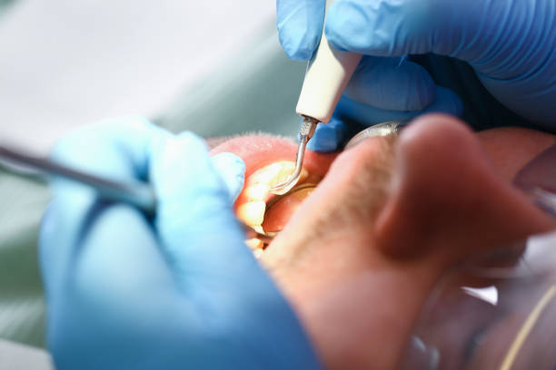 Best Emergency Treatment for Dental Infections or Abscesses in Duson, LA