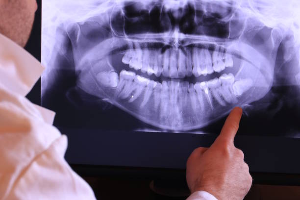Best Emergency Tooth Extraction in Duson, LA